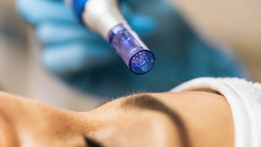 medical microneedling