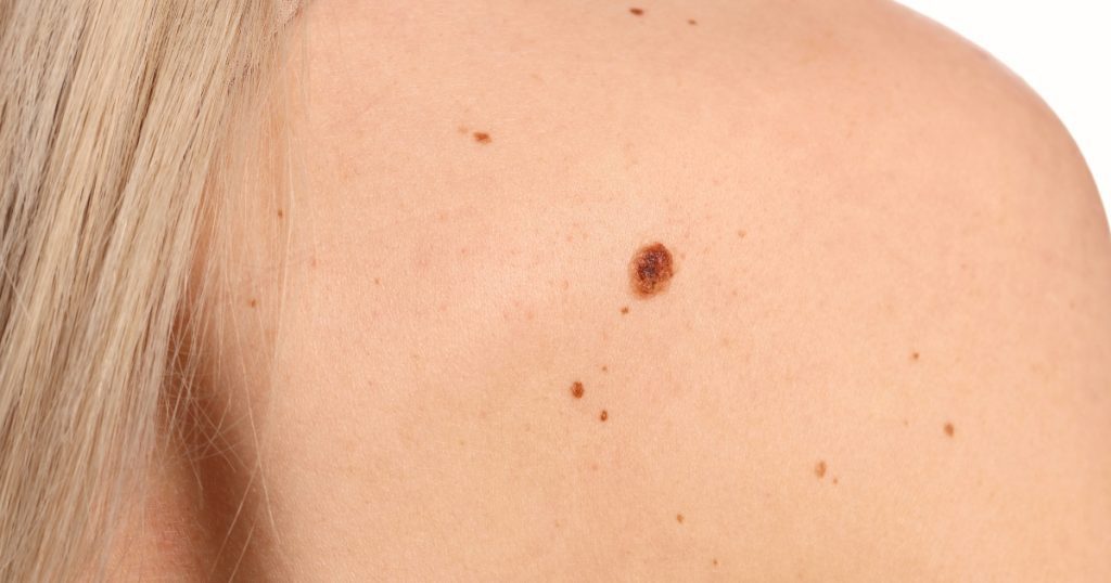 pigmented lesions